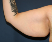 Feel Beautiful - Arm Reduction 203 - Before Photo